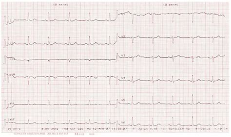 Resting ECG showing sinus rhythm with a normal heart rate. | Download ...