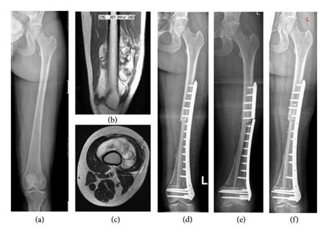 X Ray And Mri Imaging In A 31 Year Old Female Patient With Liposarcoma