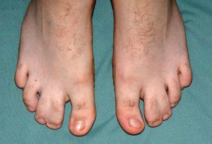 syndactyly ankle  foot clinic