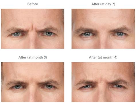 BOTOX | Before and After Galleries | Images | Photos | Chugay Cosmetic ...