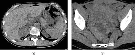 Figure From Hemoperitoneum From Corpus Luteal Cyst Rupture A