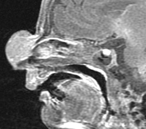 Radiological Reasoning Pediatric Midline Nasofrontal Mass Ajr