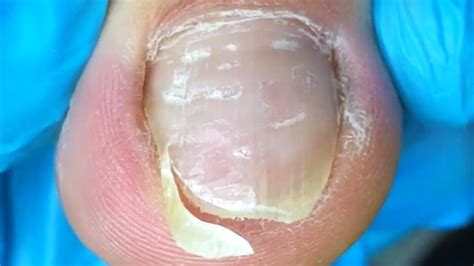 There Is A Huge Ingrown Toenail Hidden Deep Inside Dig It Out Cleanly