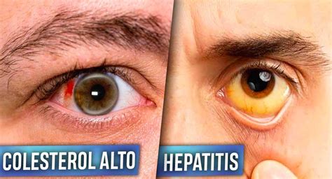 6 Enfermedades Que Tus Ojos Pueden Revelar Badabun