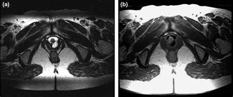 Outcomes Of Surgery Of Female Urethral Diverticula Classified Using