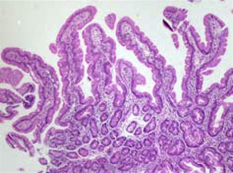 Duodenal Biopsy Specimens Case 1 Mean Increase 10× Showing