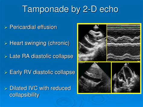 PPT - Cardiac Tamponade PowerPoint Presentation, free download - ID:5026067