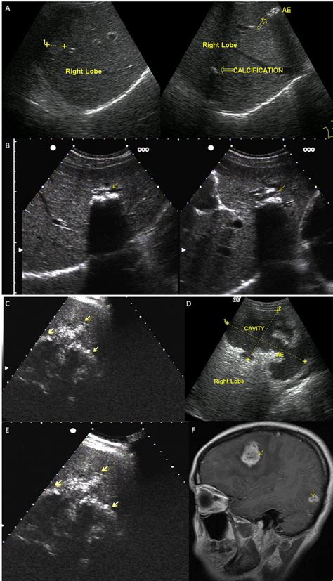 Diagnosis Treatment And Management Of Echinococcosis The Bmj