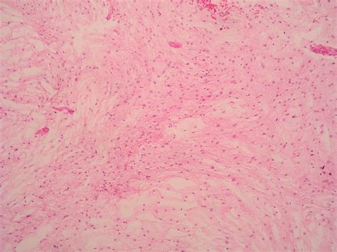 Pathology Outlines Low Grade Fibromyxoid Sarcoma