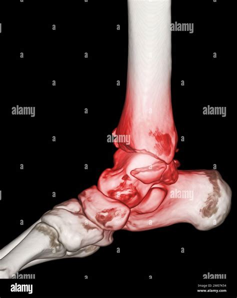 Ct Scan Cheville Et Pied Ou Tomodensitom Trie De L Articulation