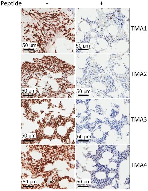 Ihc Staining Leica Bond Rx Stainer Of Multiple Myeloma Patients