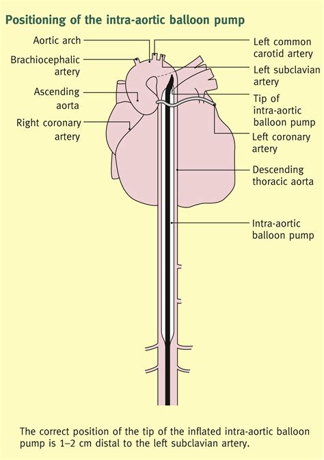 Intra Aortic Balloon Pump Placement