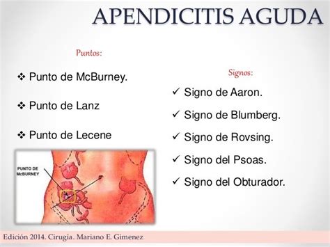 Apendicitis Aguda