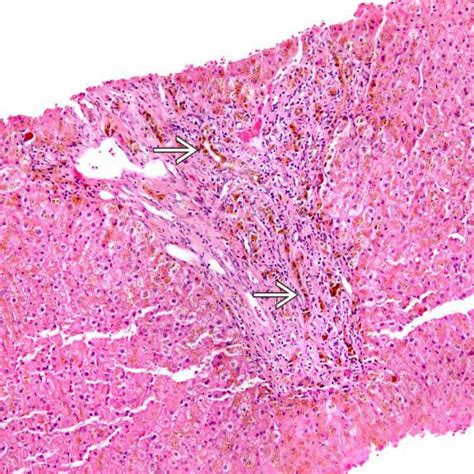 Hereditary Hemochromatosis Basicmedical Key