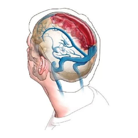 Serebral Ven Trombozu Acil Çalışanları