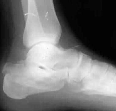 Calcaneus Fracture Imaging Practice Essentials Radiography Computed