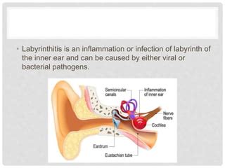 Labrinthitis PPT