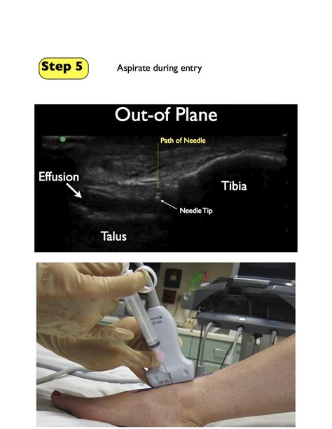 Arthrocentesis: Ankle — Highland EM Ultrasound Fueled pain management