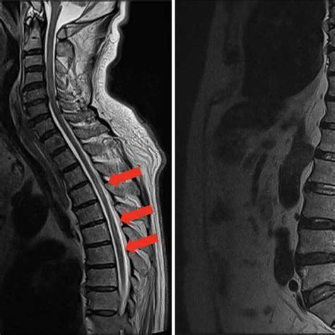 T2 Weighted Sagittal Magnetic Resonance Image Showing Spinal Cord