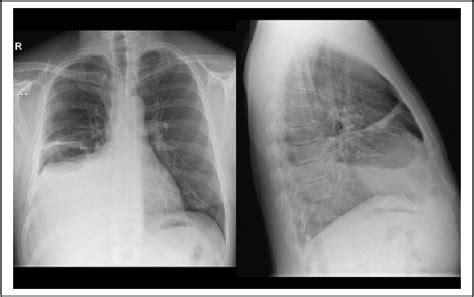 Figure 1 From Complete Remission For 4 Years With Crizotinib In