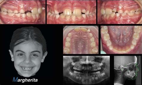 Class I Malocclusion With Transverse Maxillary Constriction Unilateral