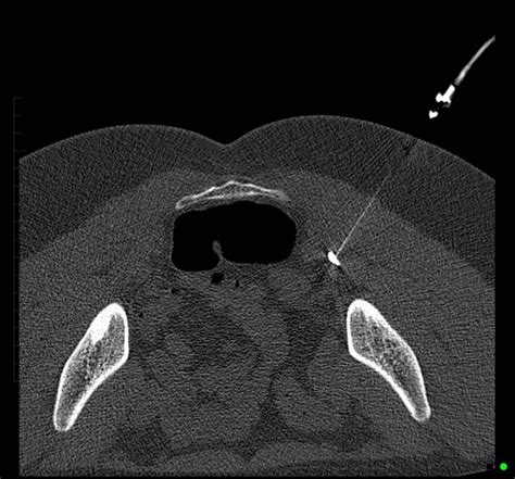 Piriformis Muscle Injection: Relief from Piriformis Syndrome