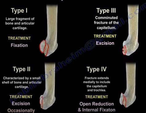 Capitellum Fractures and Classification — OrthopaedicPrinciples.com