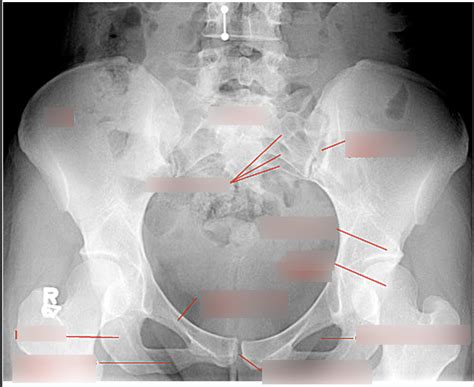 Hip Pelvis AP 2 Diagram Quizlet