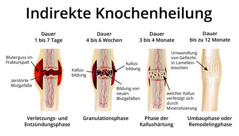 Was Bedeutet Eine Verdickung An Der Knochenbruchstelle