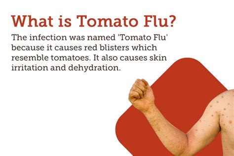 Tomato Flu Symptoms Causes Treatment And Cost