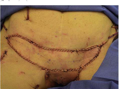 Figure From Bilateral Groin Reconstruction With A Single