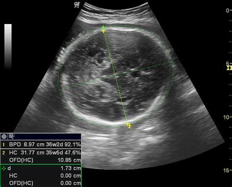 Fetal Anomalies Ultrasound