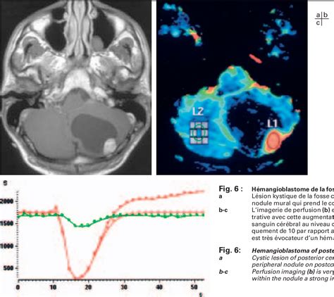 Figure 6 from IRM de perfusion des tumeurs cérébrales Semantic Scholar