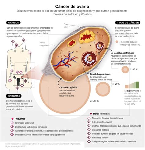 Síntomas del cáncer de ovario Diario de Cantabria