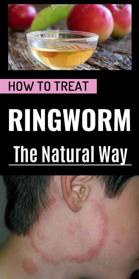 How To Treat Ringworm The Natural Way Get Rid Of Ringworm Ringworm Home Remedies For Ringworm