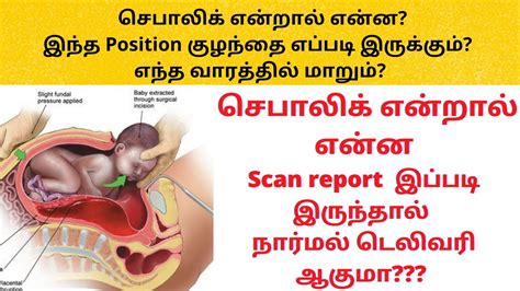 Cephalic Position Of Baby In Tamil Positions Of Baby In Womb In Tamil