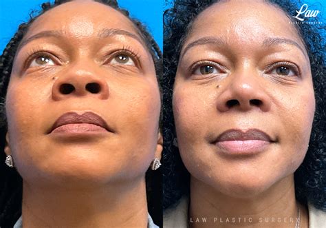 African American Rhinoplasty Before And After Photos Sage Plastic Surgery