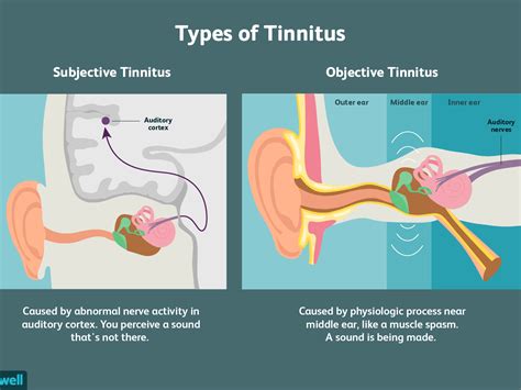 Tinnitus