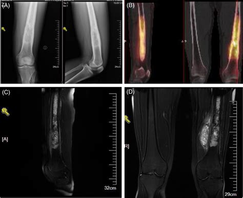 (A) The X‐ray examination showed abnormal lesion on left distal femur ...