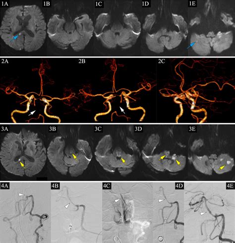 An Example Of Evt With Unfavorable Outcomes For Ais Lvo S In The