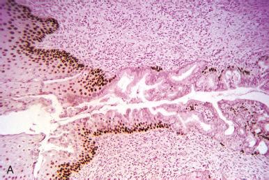 Altered Endometrial Differentiation Metaplasia Clinical Tree