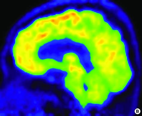 PET-CT scan of brain. PET-CT scan showed (A) symmetric decreased FDG ...