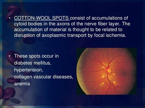 Ophthalmic Manifestations Of Hematological Malignancies