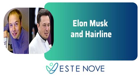 Elon Musk and Hairline - Estenove