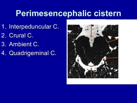 basal cisterns anatomy