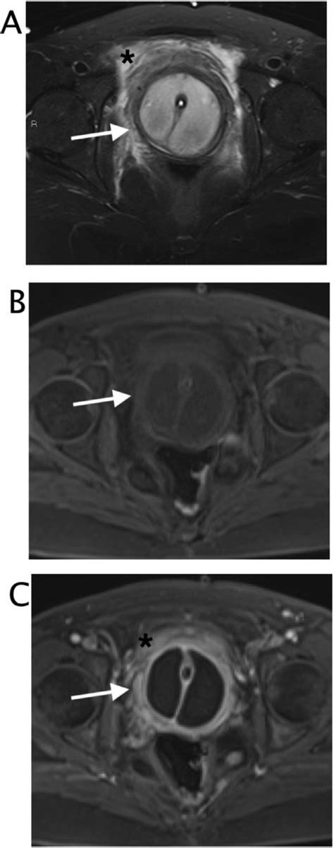 A Axial T Turbo Spin Echo Sequence With Selective Fat Suppression