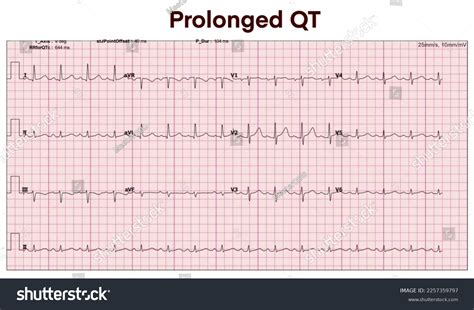 Electrocardiogram Show Qt Prolongation Heart Beat Stock Illustration