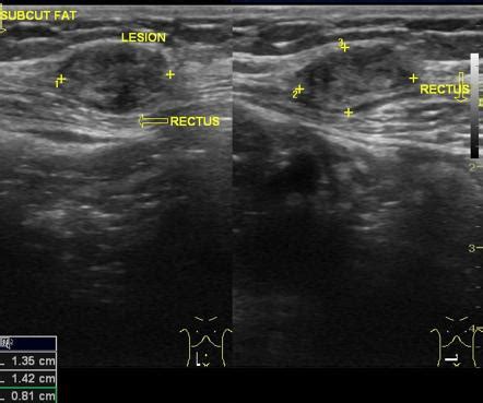 Cesarian scar endometriosis | Radiology Reference Article | Radiopaedia.org