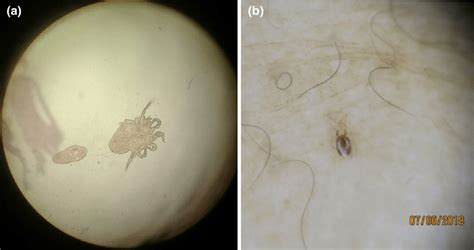 Dermanyssus Gallinae As It Appears After Microscopic Observation Download Scientific Diagram