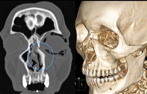 Midface Fractures What The Radiologist Should Know Semantic Scholar